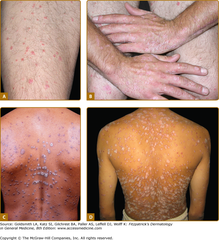 Guttate psoriasis  Guttate psoriasis, involving thigh (A), hands (B), and back (C and D). The patient in D went on to develop chronic plaque psoriasis.  Fitzpatrick's Figure 18-11