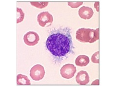 Hairy Cell Leukemia