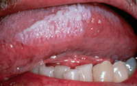 Hairy Leukoplakia  Caused by EBV  DDx- thrush- whole mouth, can be removed with red undersurface