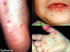 Hand, Foot, and Mouth Disease (Coxasackie A16 Virus)
