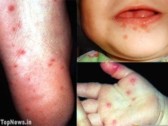 Hand-Foot-and-Mouth Disease (Coxsackie virus A16)