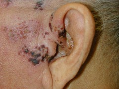 Herpes Zoster (shingles)
