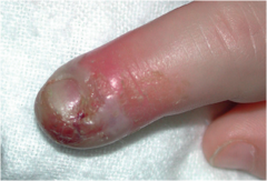 Herpetic Whitlow (Grouped vesicles on erythematous base; can quickly become pustules that rupture and crust, which may result in ulcers.)