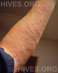 Hives  Skin rash caused by an allergic reaction