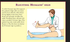 homan's sign