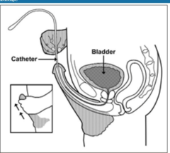 How do you eliminate after a bladder reconstruction?