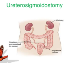 How do you eliminate after a ureterosigmoidostomy?