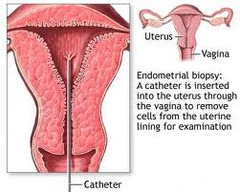 How do you manage Aytpical endometrial cells?