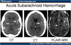 How does a acute subarachnoid hemorrhage appear on Non-Contrast CT?