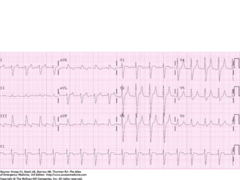 Hyperkalemia