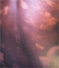 Hypopigmented Mycosis Fungoides (Cutaneous T-Cell Lymphoma.)