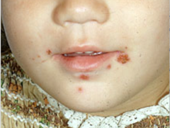 Impetigo  (BViral PP6)