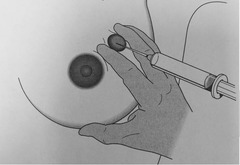 indications for use of coaxial bx needle (6 tissue sites and 1 indication)