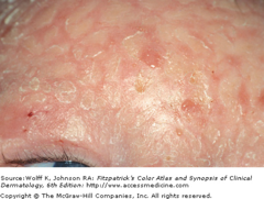 Infant Atopic Dermatitis  IgE serum immunoglobulin levels  Bacterial Culture- Often S. Aureus in nares & skin  Viral Culture- R/O HSV in crusted lesions  (Marlin D&E Lecture PP 21;24)