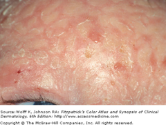 Infant Atopic Dermatitis  (Marlin D&E Lecture PP 24)