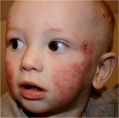 Infant Eczema