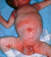 Infantile seborrheic dermatitis