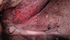 inflammatory carcinoma (also can look like mastitis) -poor prognosis
