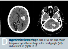 Intraparenchymal [Hypertensive] Hemorrhage