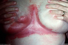 Inverse psoriasis