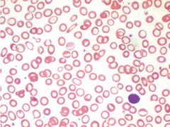 Iron deficiency anemia  hypochromic microcytic anemia