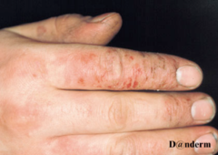 Irritant dermatitis