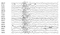 Juvenile myoclonic epilepsy EEG