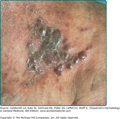 Kaposi's sarcoma:  Classic variant. Plaques and papules localized on the dorsum of the foot, a site of predilection of classic KS.  Fitzpatrick's Figure 128-1