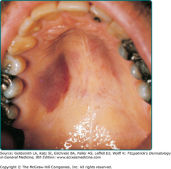 Kaposi's sarcoma:  KS lesions on the hard palate are typical manifestations of AIDS-associated KS.  Fitzpatrick's Figure 128-4