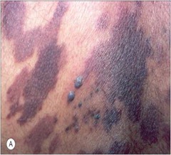 Kaposi's Sarcoma (Malignant *vascular tumor caused by HHV8*; appears as *purple* macules, papules, plaques and nodules. In classic Kaposi's Sarcoma (elderly men of Mediterranean descent), it appears as lower leg lesions. If AIDS-associated, the lesions may appear anywhere.)