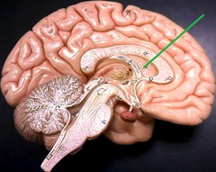 Lateral ventricle