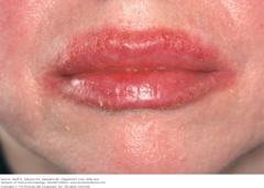 Legend: Acute allergic contact dermatitis on the lips due to lipstick   (Marlin D&E Lecture PP10)