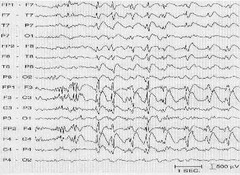 Lennox-Gastaut EEG