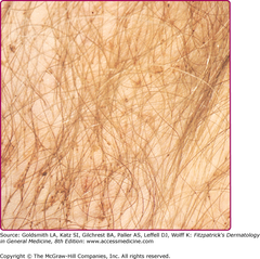 Lice: Pediculosis pubis   Pediculosis pubis. Several lice and their dot-like nits attached to the hair shafts can be seen in the pubic area of this patient.   Fitzpatrick's 8e Figure 208-6