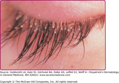 Lice  Pediculosis pubis. Eyelash infestation with Pthirus pubis. Nits can be seen attached to the eyelashes. (Used with permission from D.A. Burns, MD.)  Fitzpatrick's 8e Figure 208-7