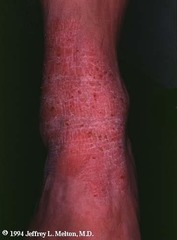Lichen Simplex Chronicus  Treatment: Interrupt the Scratch Itch cycle Topical steroids Intralesional Triamcinolone Antihistamines- particularly at night  (Marlin D&E Lecture PP56;58)