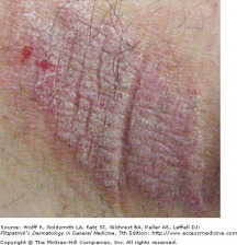 Lichenification (secondary lesion)