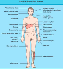 Liver signs & symptoms