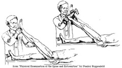 Lumbosacral nerve root irritation