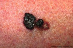 malignant melanoma