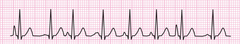 MAT (multifocal atrial tachycardia