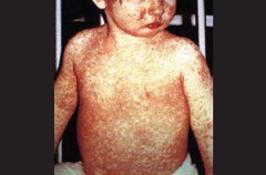 Measles - Rubeola