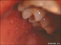 Measles - Rubeola Koplik spots on buccal mucosa.