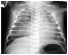 Meconium Aspiration Syndrome Next: intubate and suction before stimulation Complications: Pulmonary artery HTN, pneumonitis