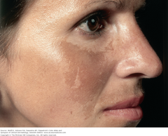 Melasma   Well-demarcated, hyperpigmented macules are seen on the cheek, nose, and upper lip.  Fitzpatrick's Figure 13-10