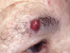 Merkel cell carcinoma