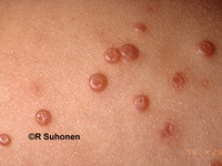 Molluscum contagiosum  Key- central umbilication  Have depressed center to the lesions  Can be large, numerous with HIV