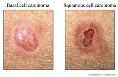 Multiple actinic keratosis with squamous cell CA in situ  AKs turn into SCC