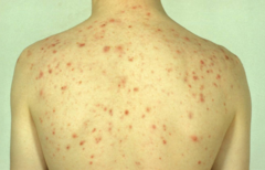 Multiple erythematous papules on the upper back