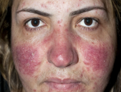 Multiple pustules, telangiectasia and flushing on the face